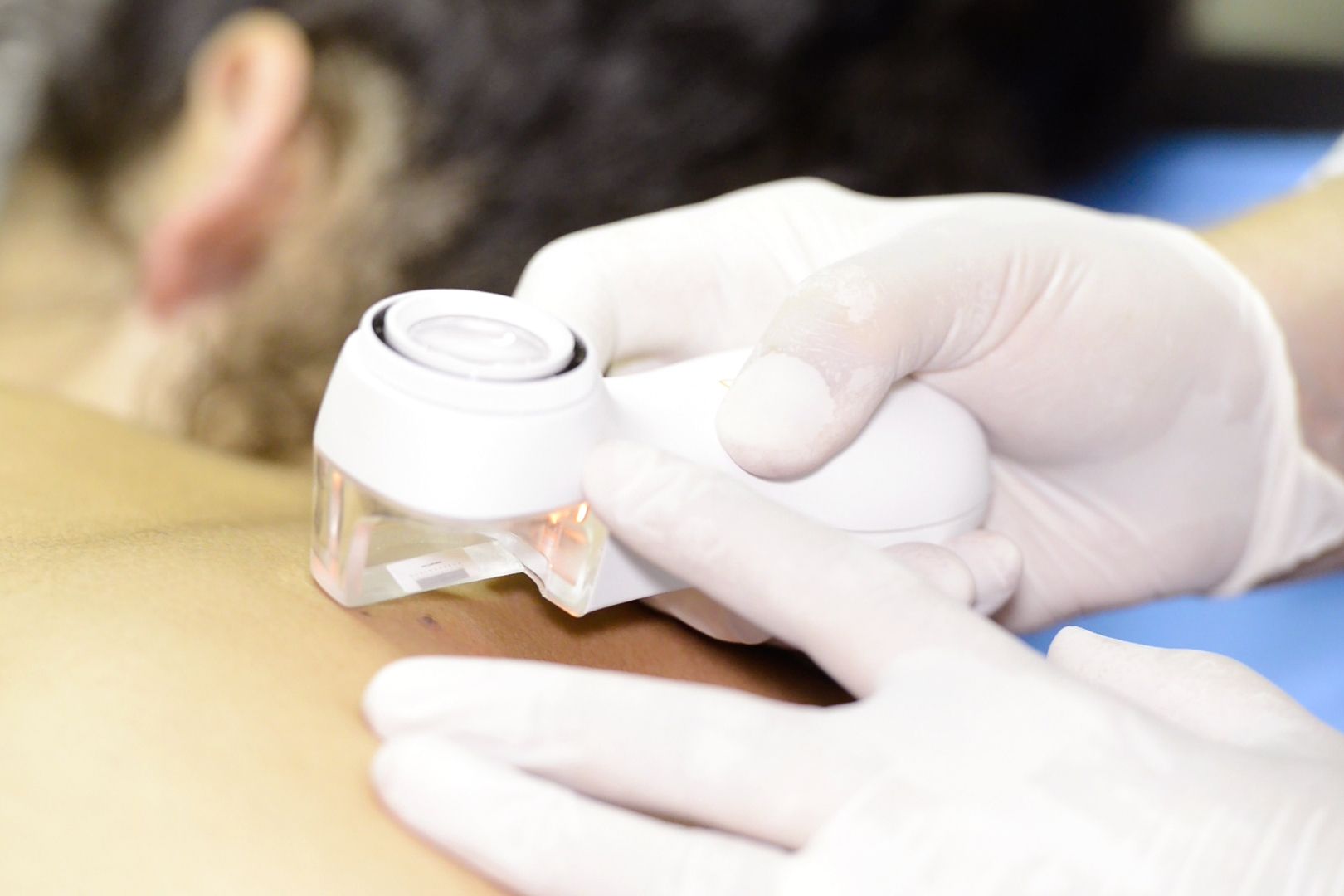 Dermatoscopia: Dermatología y Dermoestética de Dermatología Socorro Fierro Dermatoscopia: Dermatología y Dermoestética de Dermatología Socorro Fierro
