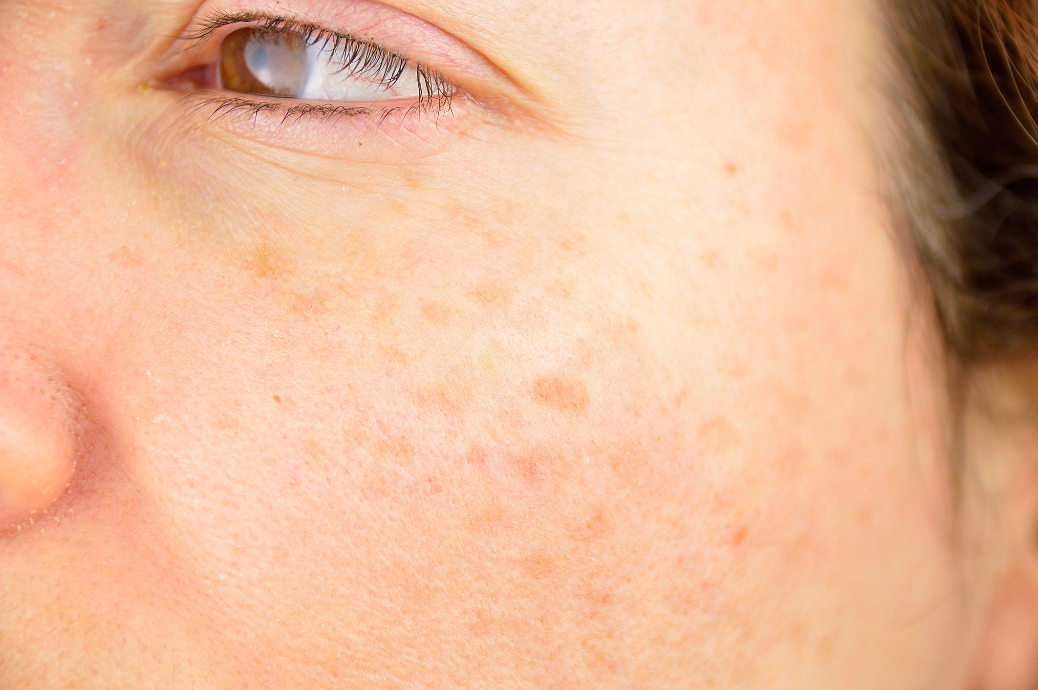 Léntigos: Dermatología y Dermoestética de Dermatología Socorro Fierro Léntigos: Dermatología y Dermoestética de Dermatología Socorro Fierro