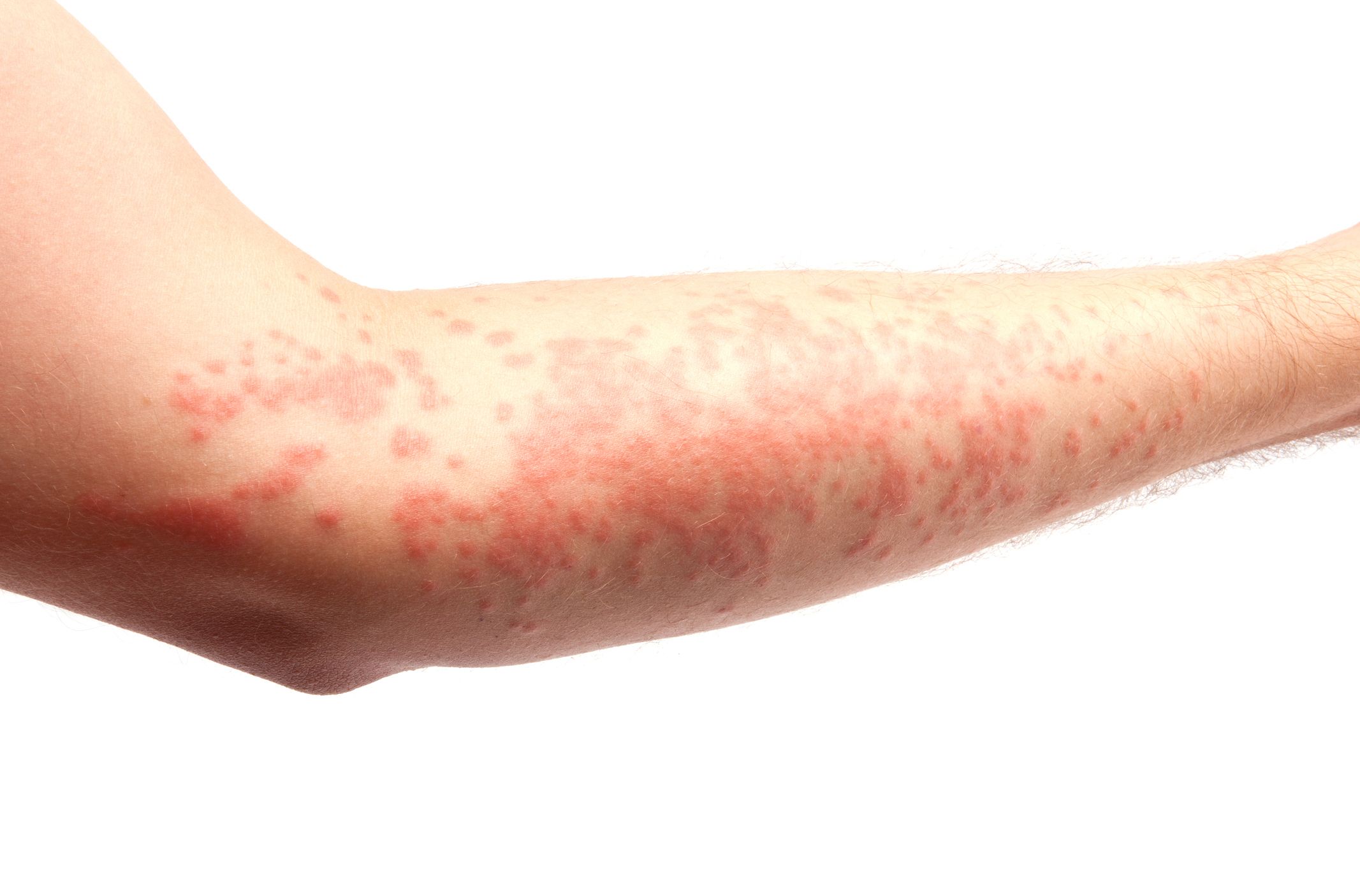Urticaria: Dermatología y Dermoestética de Dermatología Socorro Fierro Urticaria: Dermatología y Dermoestética de Dermatología Socorro Fierro