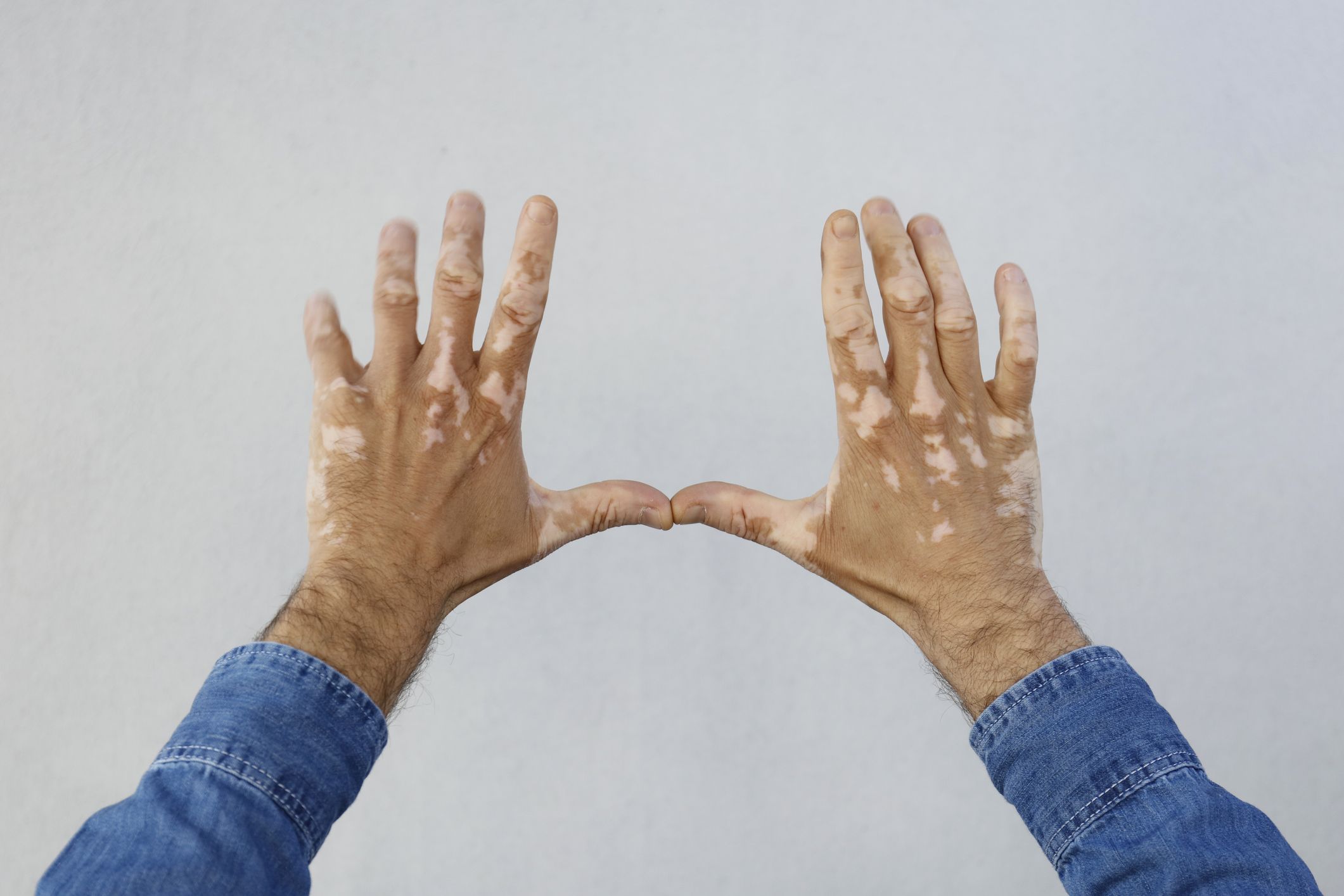 Vitíligo: Dermatología y Dermoestética de Dermatología Socorro Fierro Vitíligo: Dermatología y Dermoestética de Dermatología Socorro Fierro