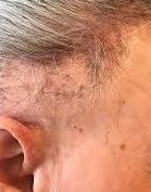 Alopecia: Dermatología y Dermoestética de Dermatología Socorro Fierro Alopecia: Dermatología y Dermoestética de Dermatología Socorro Fierro