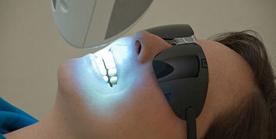 Blanqueamiento dental  : Tratamientos de Clínica Dental Center