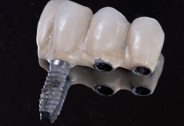 Implantes : Tratamientos de Clínica Dental Center