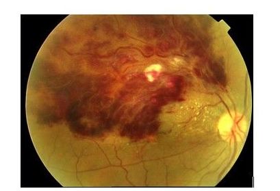 Trombosis venosa retiniana : Patologías oculares de ...