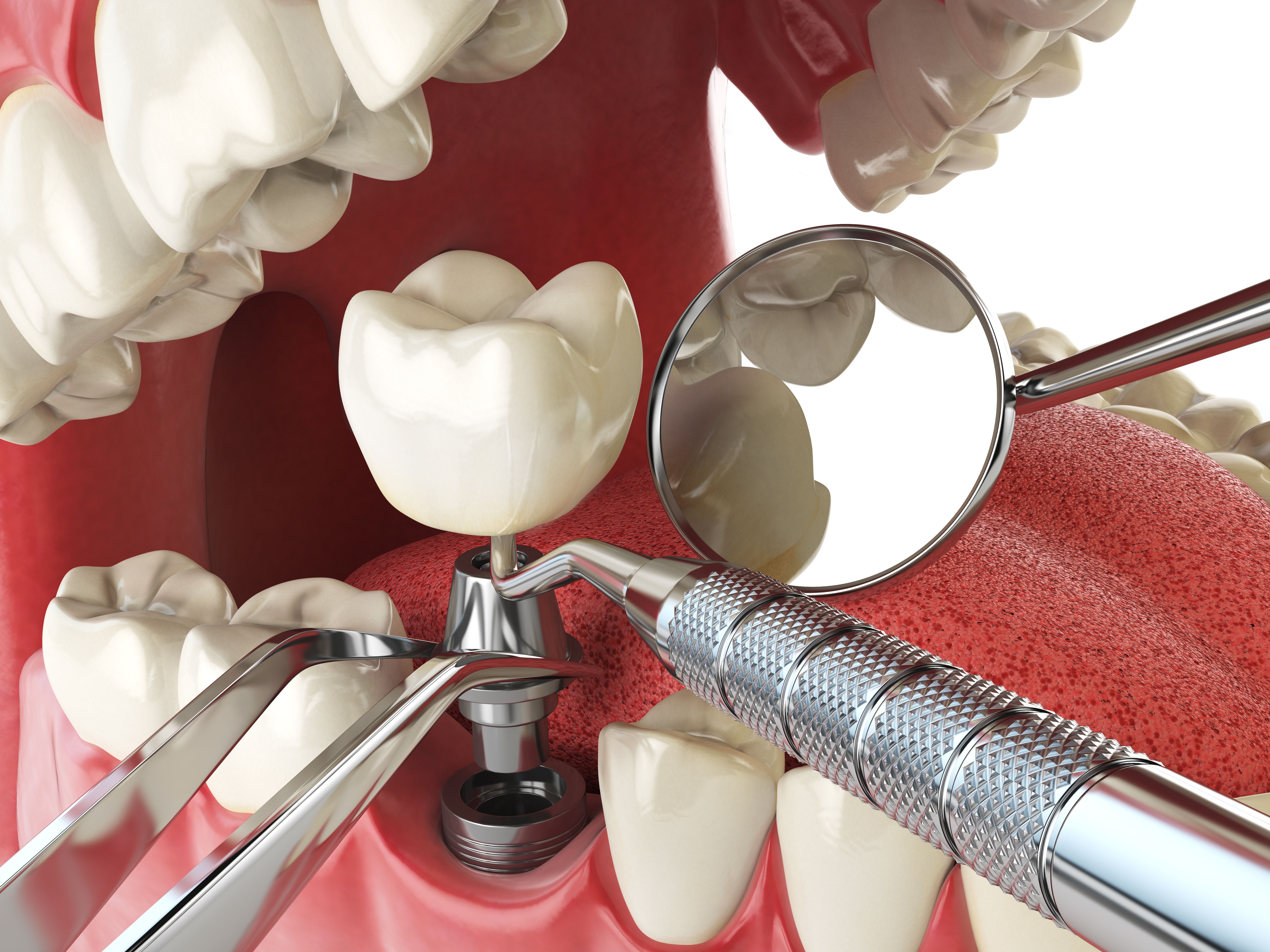 Implantes: Especialidades de Centre Mèdic Montblanc Implantes: Especialidades de Centre Mèdic Montblanc
