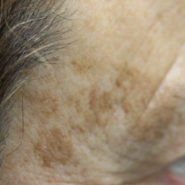 Manchas: lentigos y melasma: Tratamientos de Clínica Dermañueco