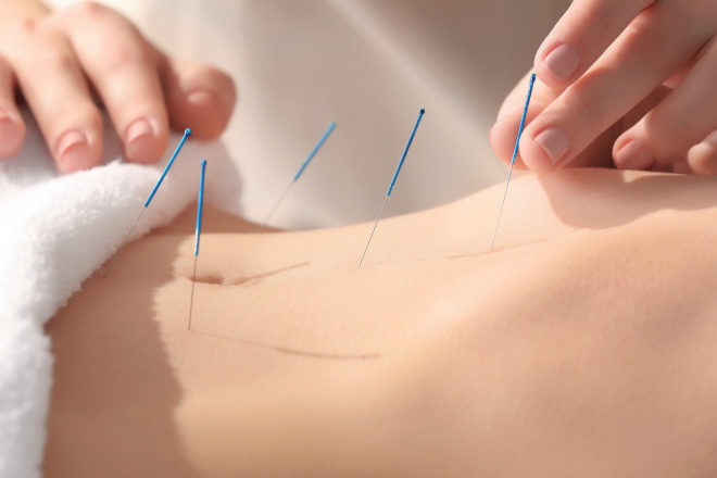 Acupuntura: Servicios de Dala Beauty Salon Acupuntura: Servicios de Dala Beauty Salon