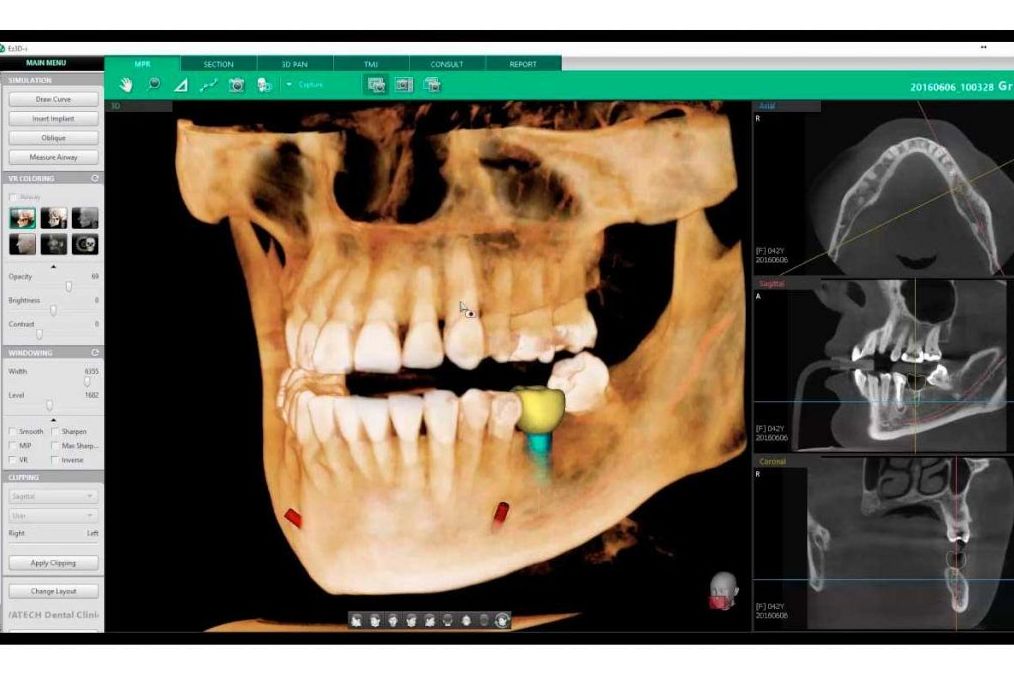 TAC - RADIOGRAFÍAS EN 3D: Tratamientos de Clínica Dental Santa Eulàlia TAC - RADIOGRAFÍAS EN 3D: Tratamientos de Clínica Dental Santa Eulàlia