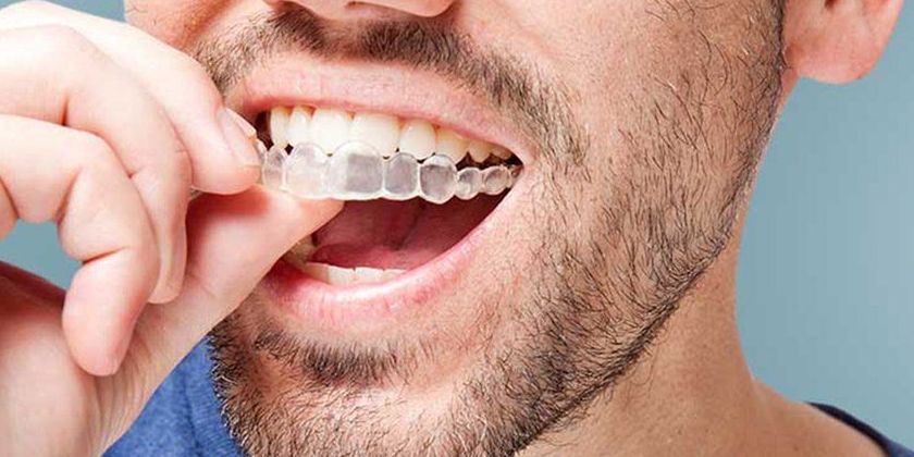 ORTODONCIA INVISALIGN : Tratamientos de Clínica Dental Santa Eulàlia ORTODONCIA INVISALIGN : Tratamientos de Clínica Dental Santa Eulàlia