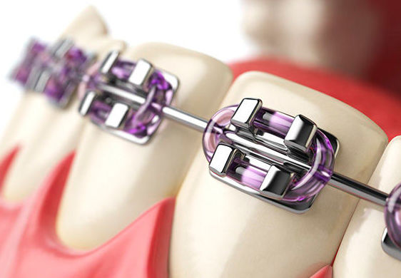 ORTODONCIA CON BRACKETS: Tratamientos de Clínica Dental Santa Eulàlia ORTODONCIA CON BRACKETS: Tratamientos de Clínica Dental Santa Eulàlia