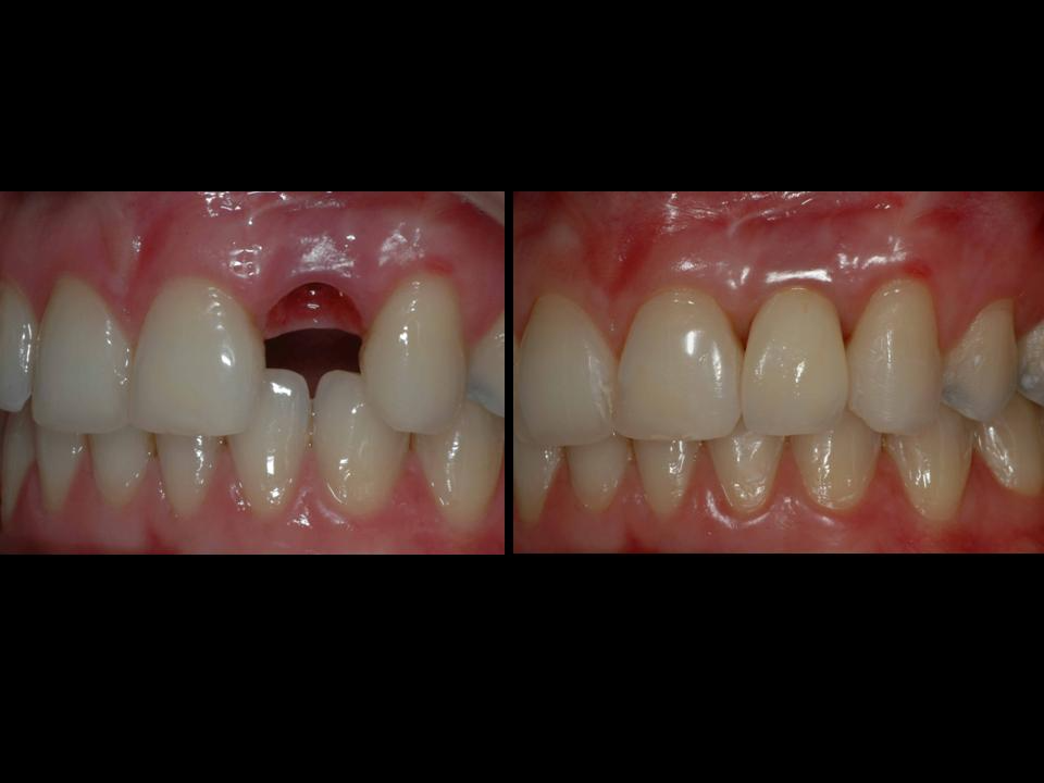 Implantes de alta gama certificados internacionalmente: Servicios de CLÍNICA DENTAL LAS REDES Implantes de alta gama certificados internacionalmente: Servicios de CLÍNICA DENTAL LAS REDES