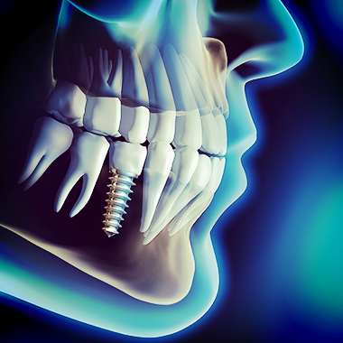 Implantes de alta gama certificados internacionalmente: Servicios de CLÍNICA DENTAL LAS REDES Implantes de alta gama certificados internacionalmente: Servicios de CLÍNICA DENTAL LAS REDES