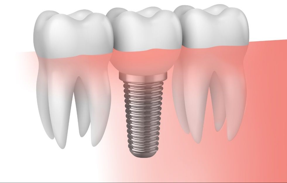 Implantes de alta gama certificados internacionalmente: Servicios de CLÍNICA DENTAL LAS REDES Implantes de alta gama certificados internacionalmente: Servicios de CLÍNICA DENTAL LAS REDES