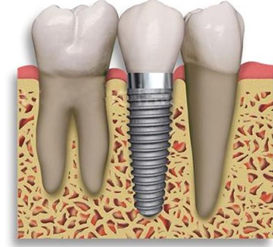 Implantología: Catálogo de Edent Clínica Dental - Dra. Celia Caba Implantología: Catálogo de Edent Clínica Dental - Dra. Celia Caba