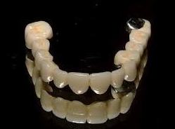 Metal Cerámica: Servicios de Clínica Dental Prat Casanovas