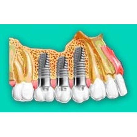 Implantes: Tratamientos de Leandro Romero Esteban Implantes: Tratamientos de Leandro Romero Esteban