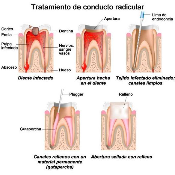Endodoncia: Tratamientos de Dentamia Endodoncia: Tratamientos de Dentamia