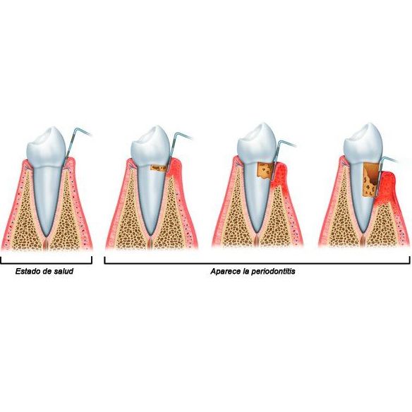 Periodoncia: Tratamientos de Dentamia Periodoncia: Tratamientos de Dentamia