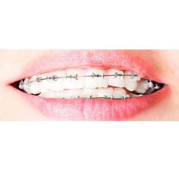 Ortodoncia: Tratamientos de Dentamia Ortodoncia: Tratamientos de Dentamia