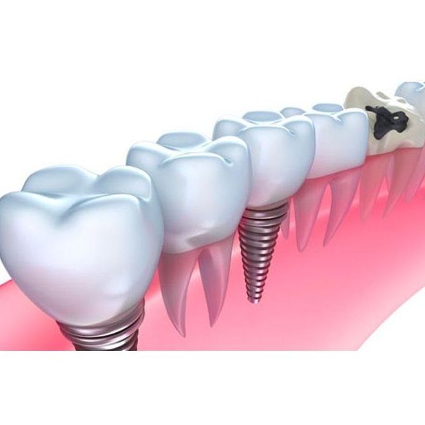 Implantes: Tratamientos de Dentamia Implantes: Tratamientos de Dentamia