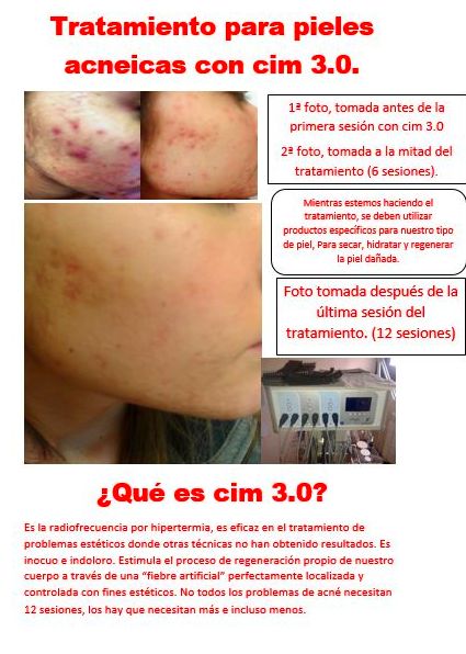Tratamiento del Acné en Oviedo Tratamiento del Acné en Oviedo