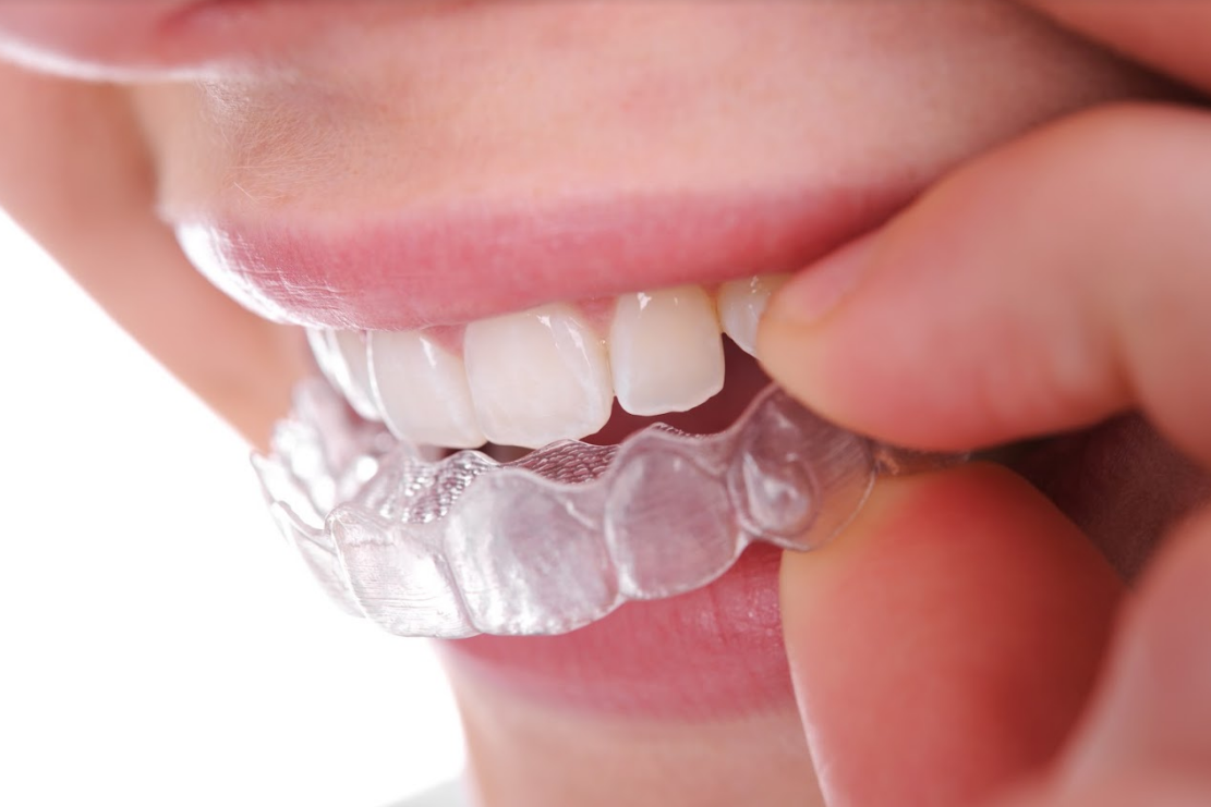 Ortodoncia invisible (Invisaling): Servicios  de Clínica Dental Sanclemente }}