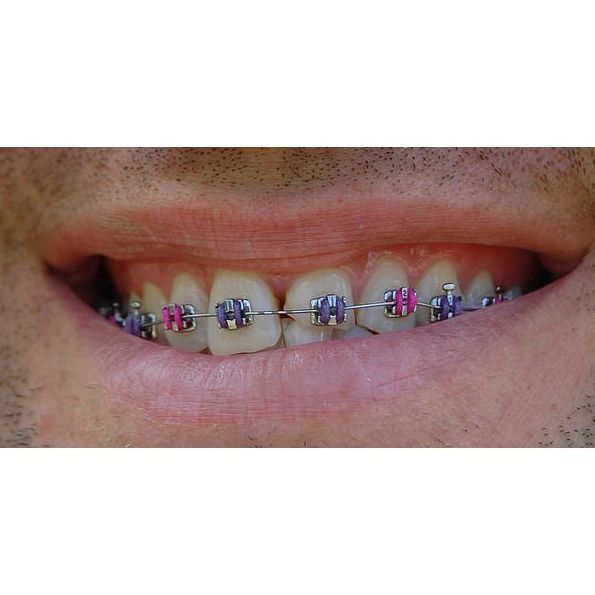 Ortodoncia: Servicios  de Clínica Dental Sanclemente