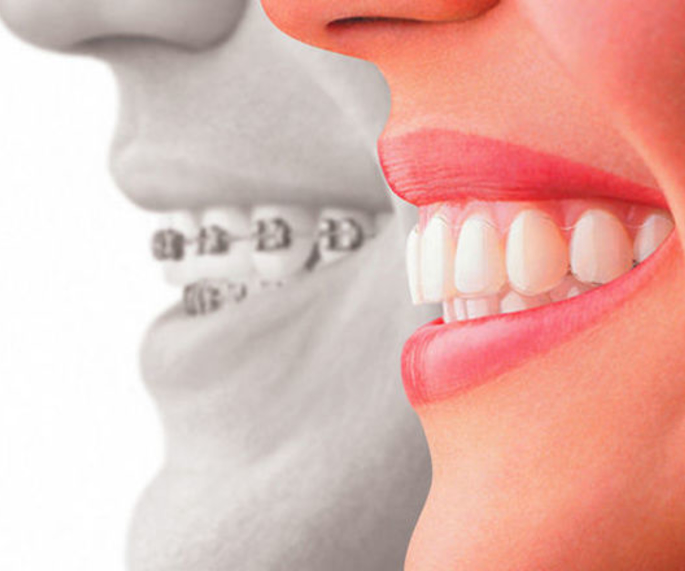 Ortodoncia: Tratamientos de Cruz Dental Ortodoncia: Tratamientos de Cruz Dental