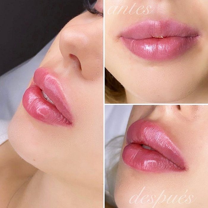 Labios: de Clínica Belice Labios: de Clínica Belice