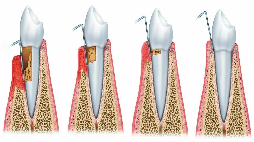 Periodoncia: Tratamientos de Clínica Dental Tàrrega - Guissona Periodoncia: Tratamientos de Clínica Dental Tàrrega - Guissona