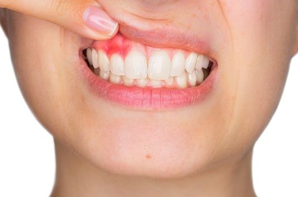Periodoncia: Tratamientos de Clínica Dental Tàrrega - Guissona Periodoncia: Tratamientos de Clínica Dental Tàrrega - Guissona