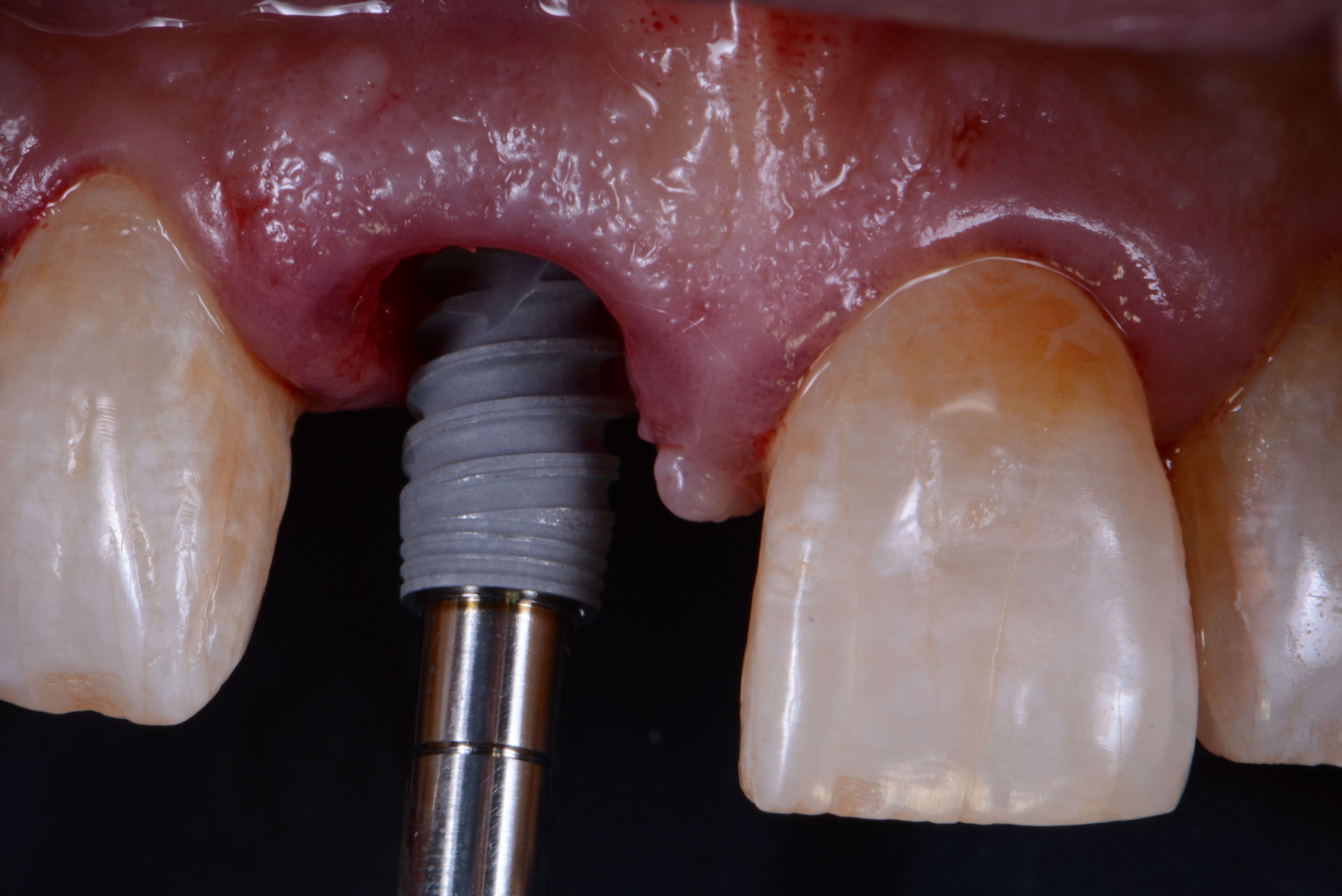 Implantología: Tratamientos de Clínica Dental Tàrrega - Guissona Implantología: Tratamientos de Clínica Dental Tàrrega - Guissona