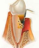 Periodoncia: Tratamientos de Clínica Dental Tárrega - Guissona Periodoncia: Tratamientos de Clínica Dental Tárrega - Guissona