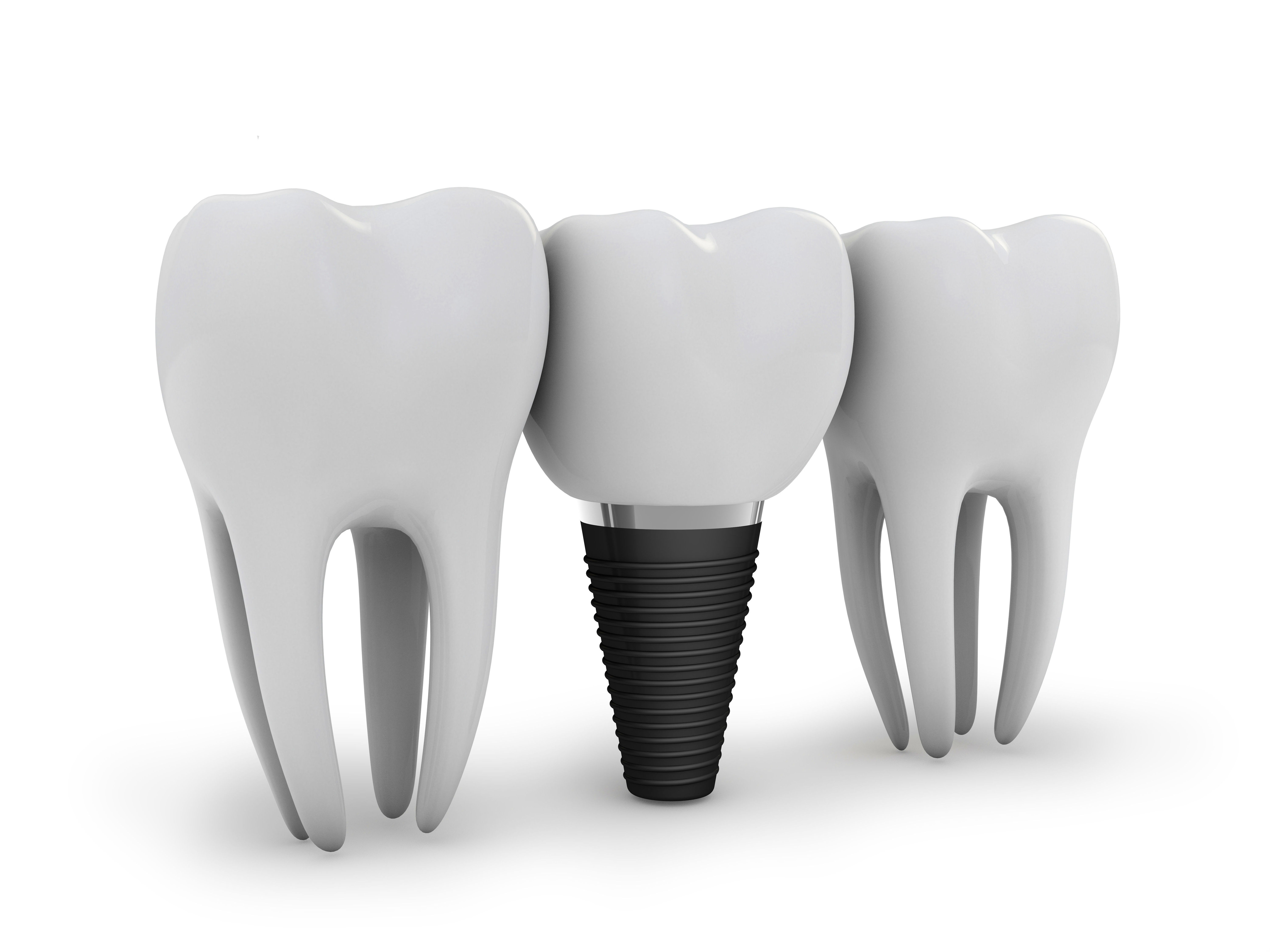 Implantes dentales: Tratamientos de Clínica Dental Tárrega - Guissona Implantes dentales: Tratamientos de Clínica Dental Tárrega - Guissona