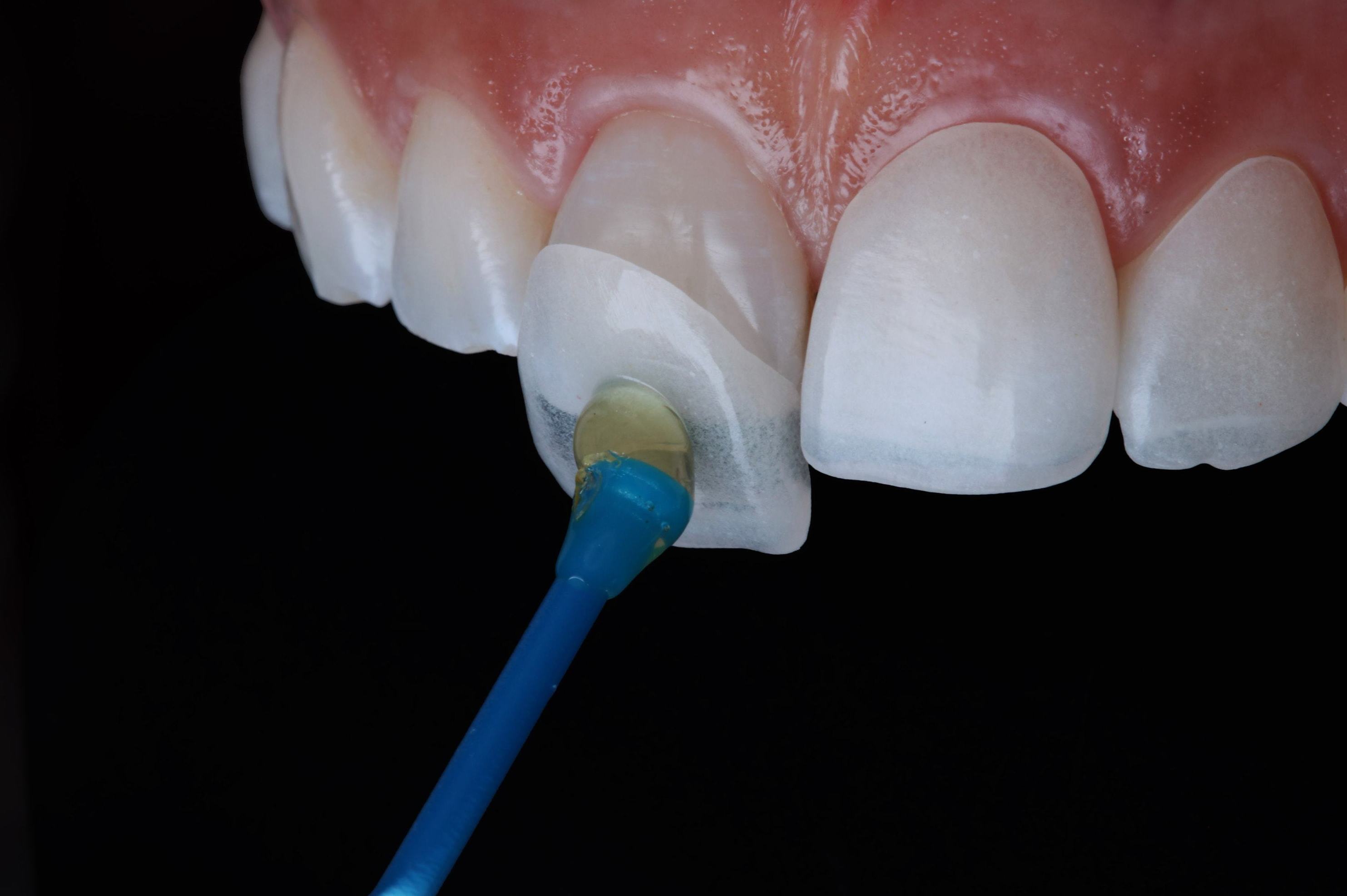 Estética dental : Tratamientos de Clínica Dental Tàrrega - Guissona Estética dental : Tratamientos de Clínica Dental Tàrrega - Guissona