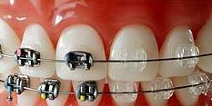 Ortodoncia: Tratamientos de Clínica Dental Tárrega - Guissona Ortodoncia: Tratamientos de Clínica Dental Tárrega - Guissona