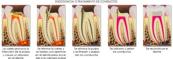 Endodóncia o tratamiento de conductos: Tratamientos de Hospident Clínica Dental Endodóncia o tratamiento de conductos: Tratamientos de Hospident Clínica Dental