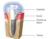 Mantenimiento de los implantes: Tratamientos de Hospident Clínica Dental Mantenimiento de los implantes: Tratamientos de Hospident Clínica Dental