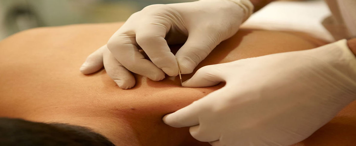 Punción seca: Tratamientos de Fisioterapia T-Cuida Punción seca: Tratamientos de Fisioterapia T-Cuida