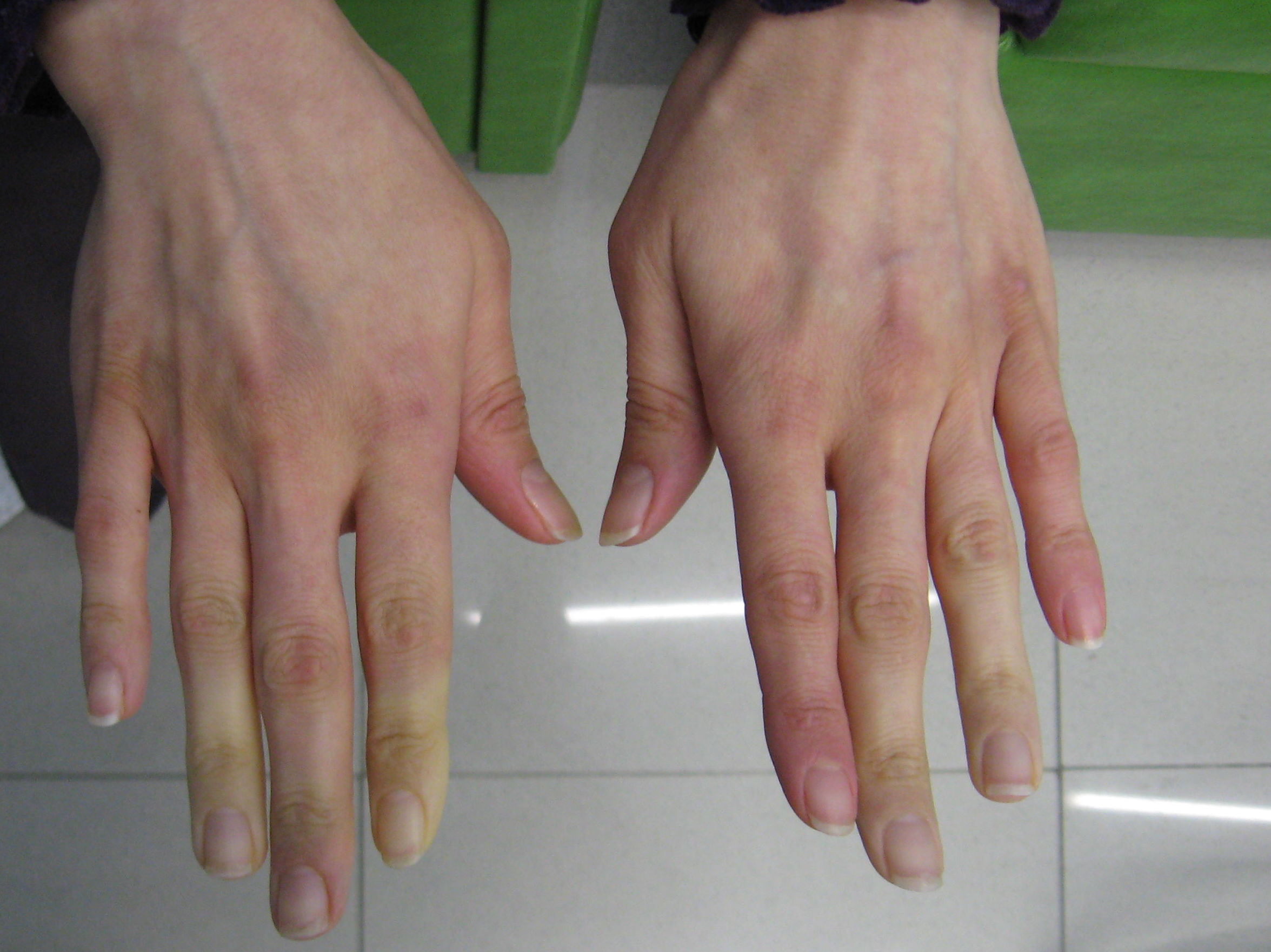 Fisioterapia reumatológica : Tratamientos de Fisioterapia T-Cuida Fisioterapia reumatológica : Tratamientos de Fisioterapia T-Cuida