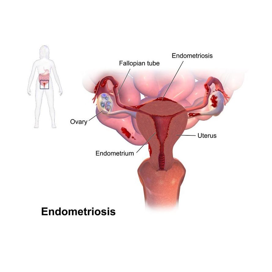 Endometriosis: Nuestros Tratamientos de Clínica Ginecológica Dr. Silva Endometriosis: Nuestros Tratamientos de Clínica Ginecológica Dr. Silva