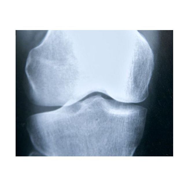 Osteoporosis: Nuestros Tratamientos de Clínica Ginecológica Dr. Silva Osteoporosis: Nuestros Tratamientos de Clínica Ginecológica Dr. Silva