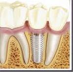 Implantes: Tratamientos de Centro Dental Innova Implantes: Tratamientos de Centro Dental Innova