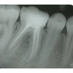 Endodoncia: Tratamientos de Centro Dental Innova Endodoncia: Tratamientos de Centro Dental Innova
