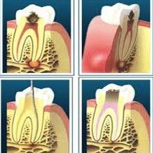 Endodoncia: Tratamientos de Centro Dental Innova Endodoncia: Tratamientos de Centro Dental Innova
