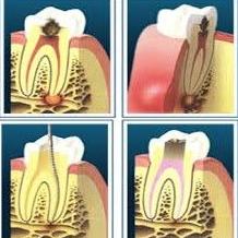 Endodoncia: Tratamientos de VERÓNICA URZÚA JATIB