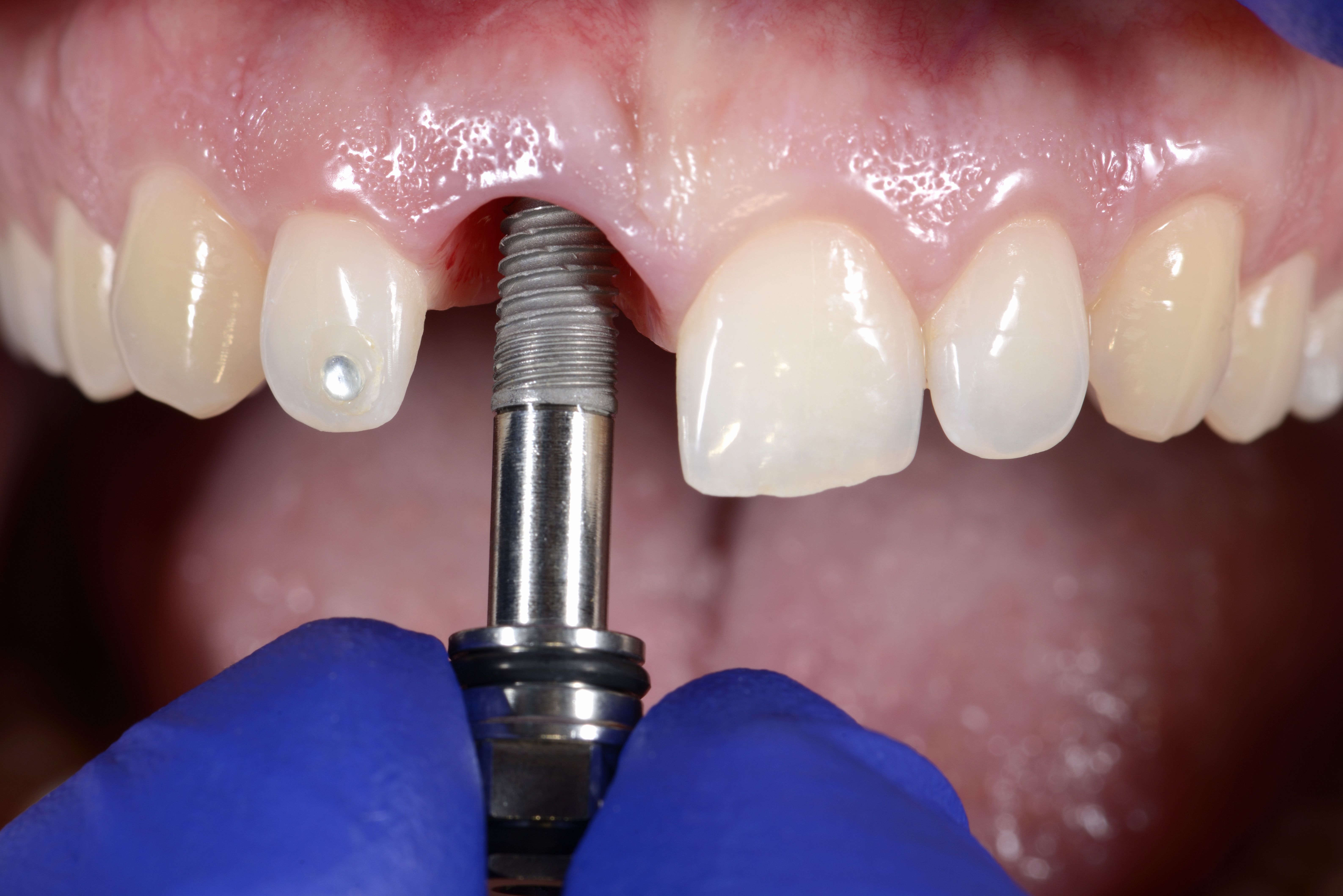 Implantes: Servicios de Clínica Dental Vendrell Casares Implantes: Servicios de Clínica Dental Vendrell Casares