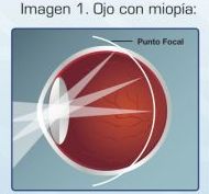 Lentes de contacto para el control de la miopía: Óptica y audiología de CENTRO OPTIFON (Óptica & Audiología) Lentes de contacto para el control de la miopía: Óptica y audiología de CENTRO OPTIFON (Óptica & Audiología)