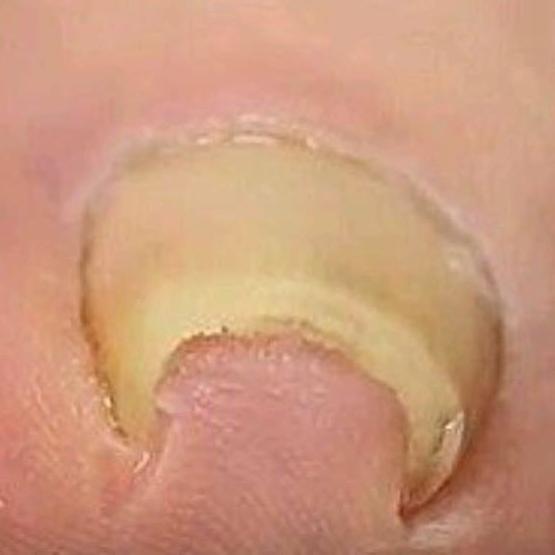 Tratar uñas clavadas Tratar uñas clavadas