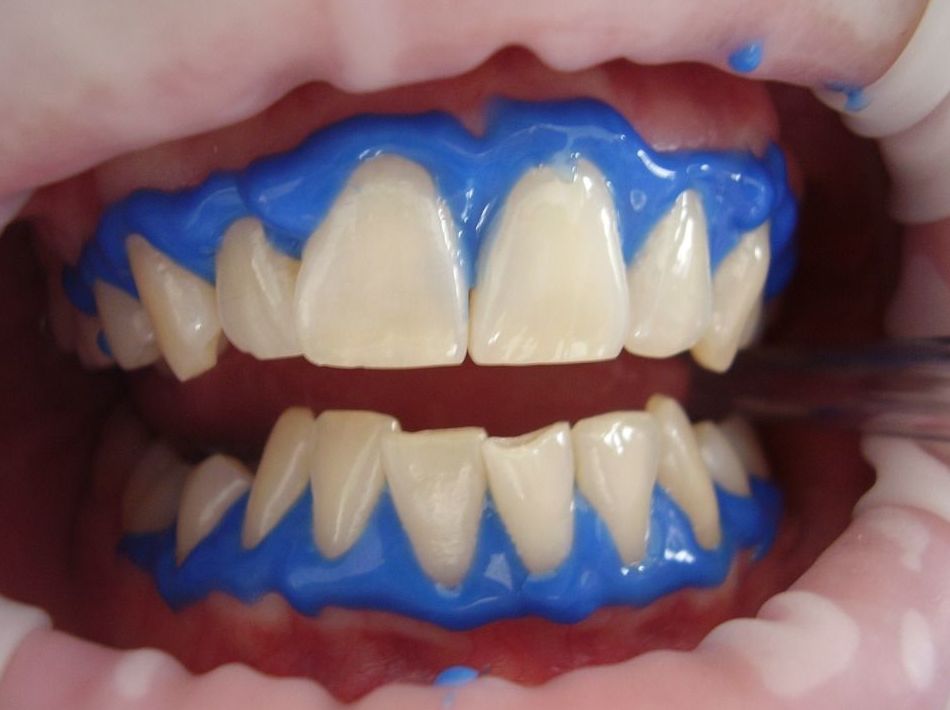 BLANQUEAMIENTO DENTAL: Catálogo de Samuel Cumplido Santiago, Dr. BLANQUEAMIENTO DENTAL: Catálogo de Samuel Cumplido Santiago, Dr.